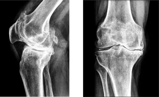 Gonartroza articulației genunchiului la radiografie