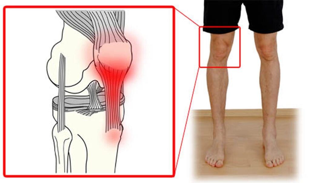 Tendinita – inflamația tendoanelor din articulația genunchiului