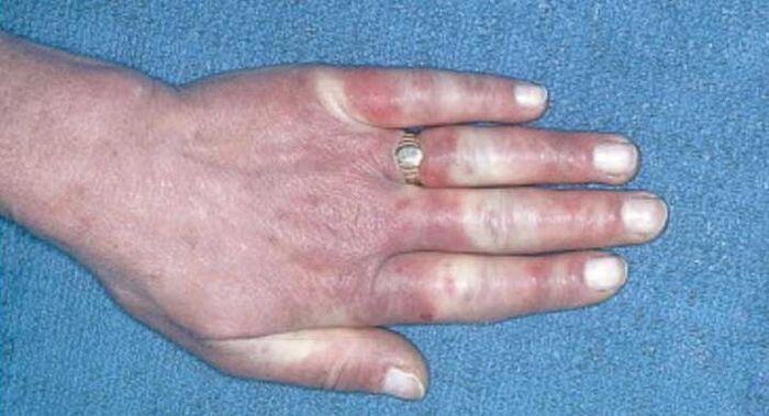 Tabloul clinic al sindromului Raynaud - vasospasm, hiperemie, edem