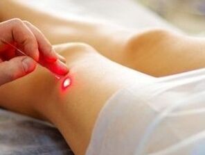 Tratamentul artrozei articulației genunchiului cu un laser